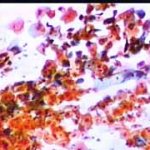 Πολυμορφία κυττάρων όλων των κυτταρικών στιβάδων. Μεγέθυνση 10Χ10